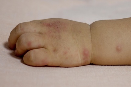 Parents warned of Autumn nursery outbreaks of hand, foot and mouth disease